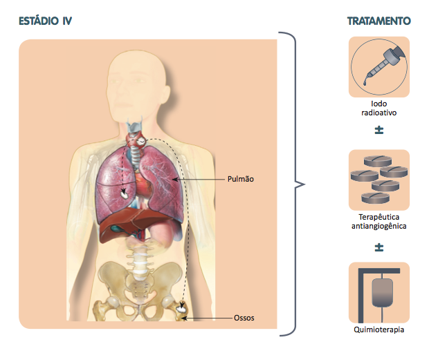 cancer de tireoide tratamento