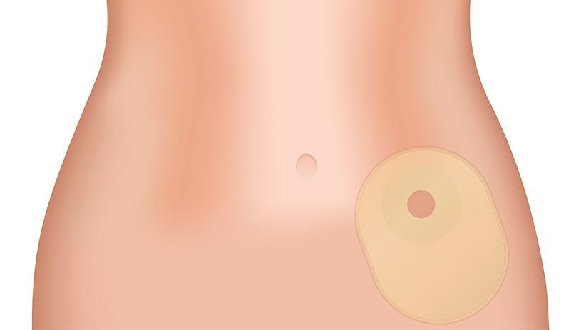 Resultado de imagem para ostomizados